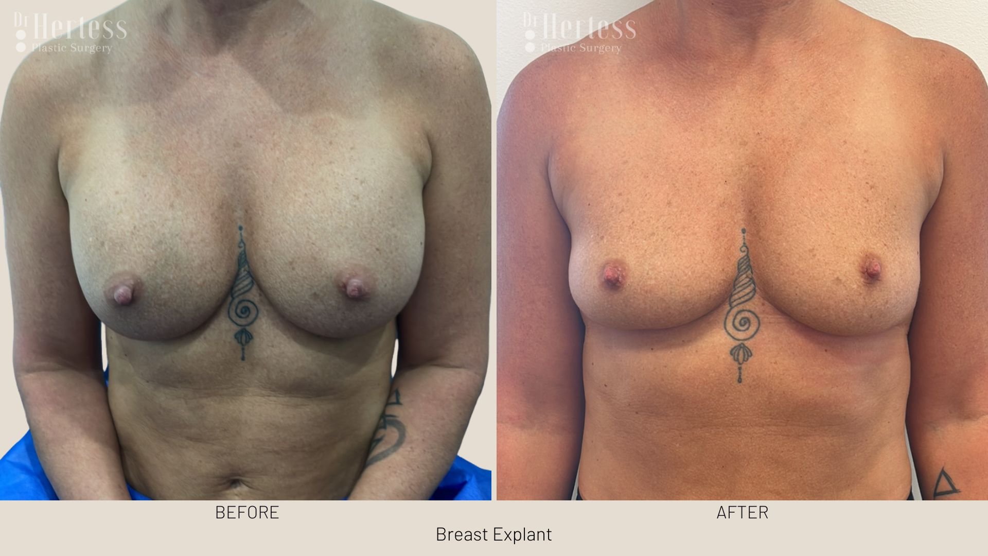 breast implant removal before and after