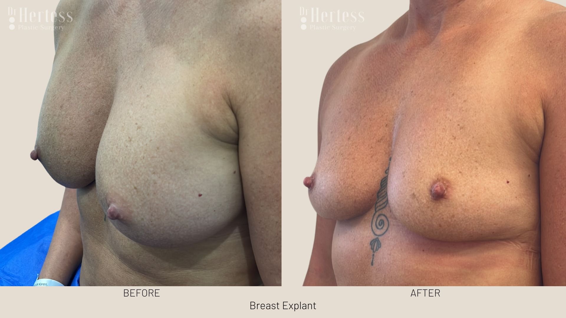 breast implant removal before and after