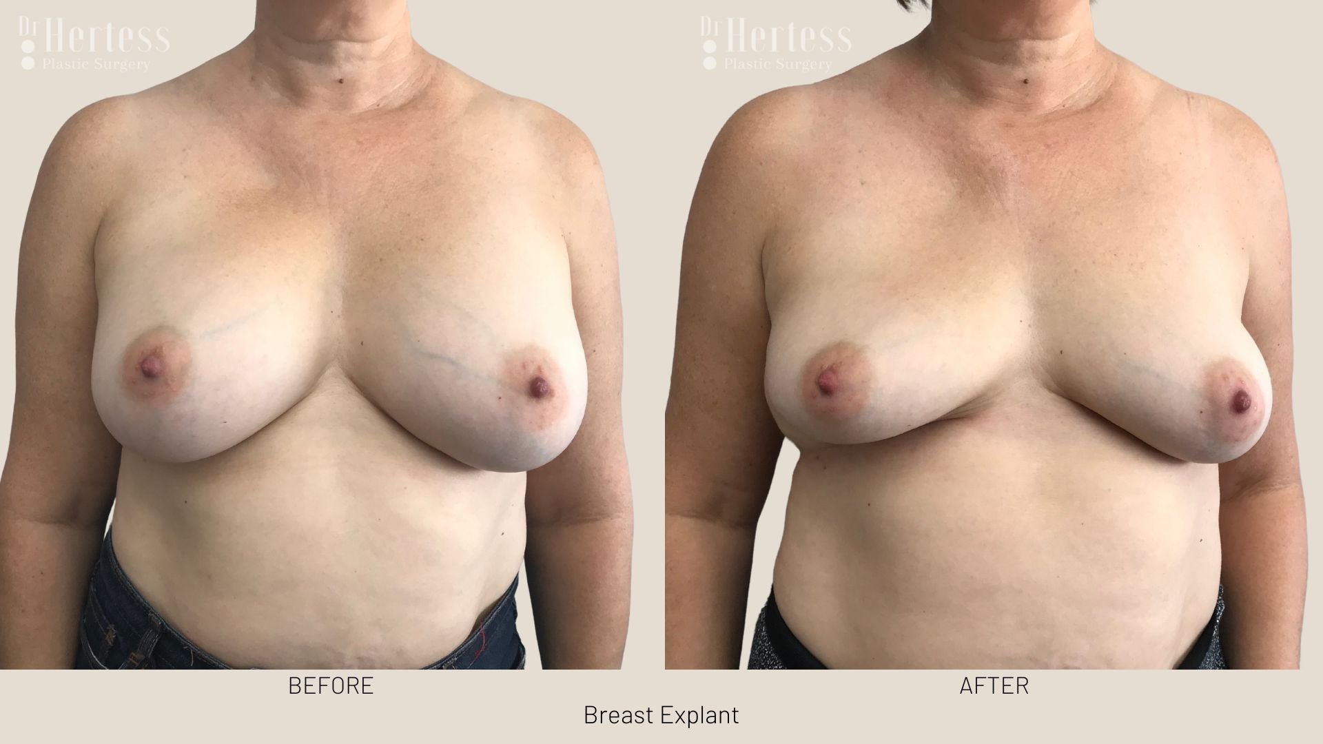 breast implant removal before and after