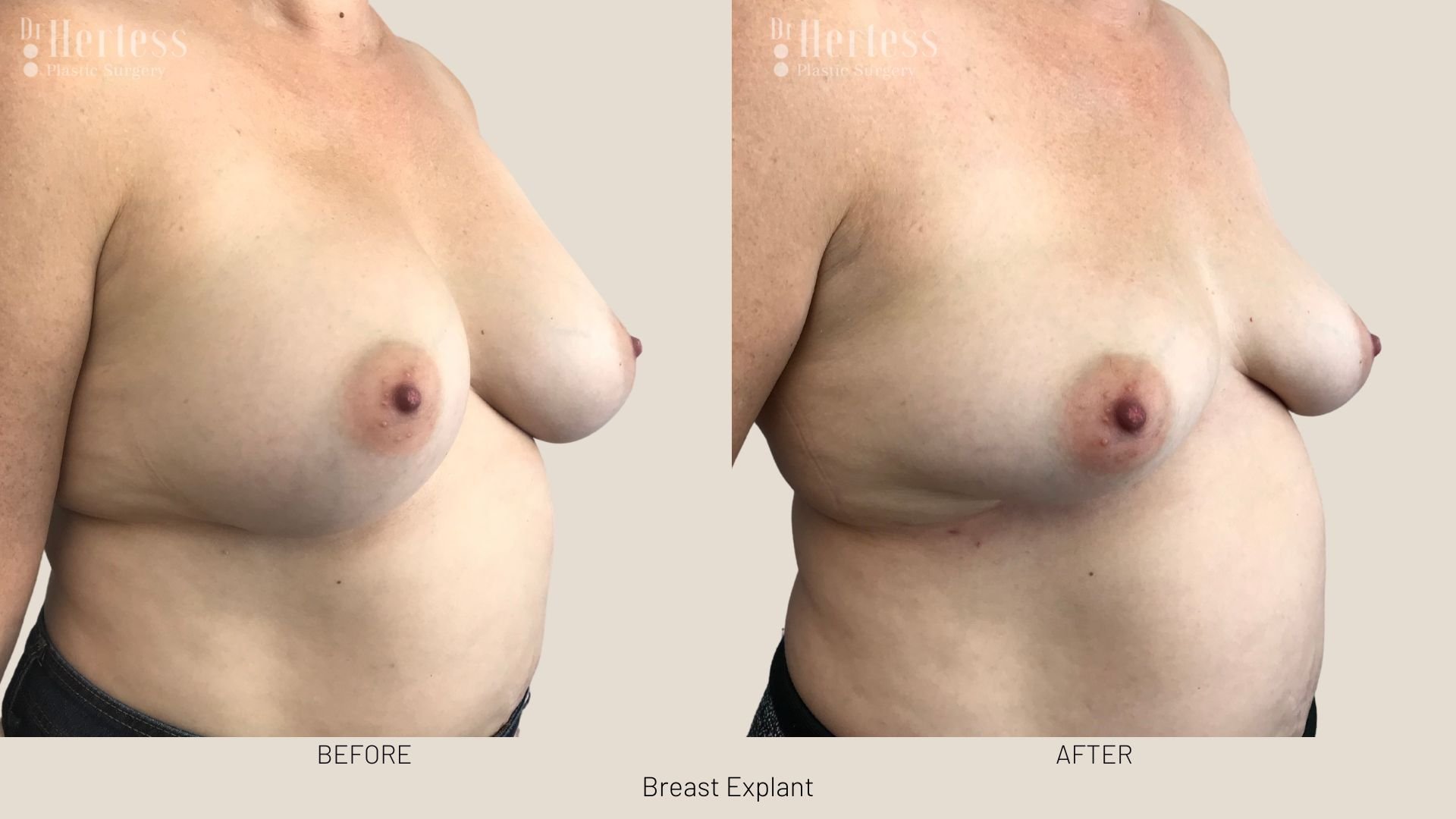 breast implant removal before and after