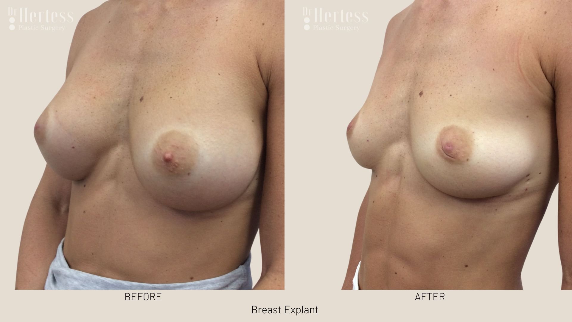 breast explant before and after