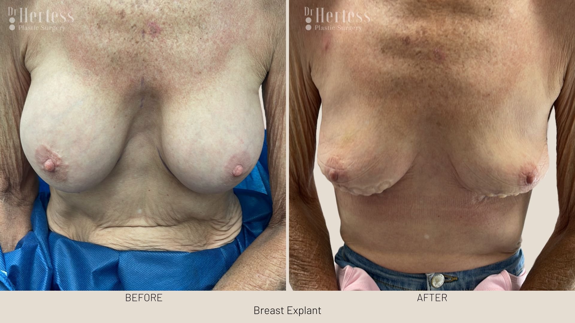 breast implant removal before and after