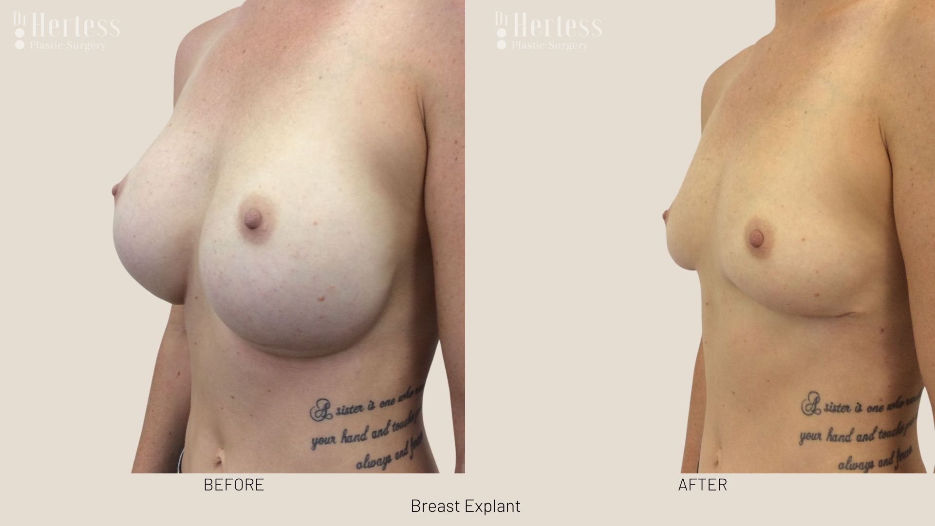 breast implant removal before and after