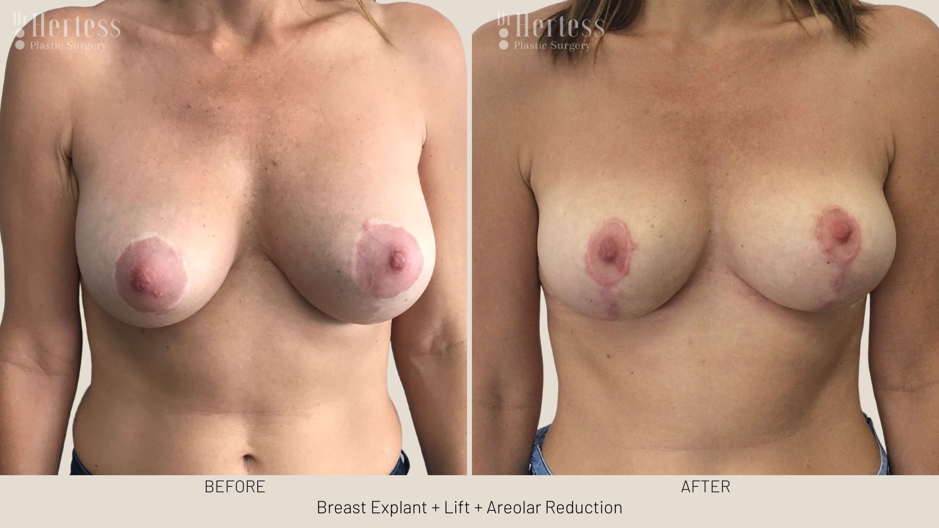 breast explant and lift before and after