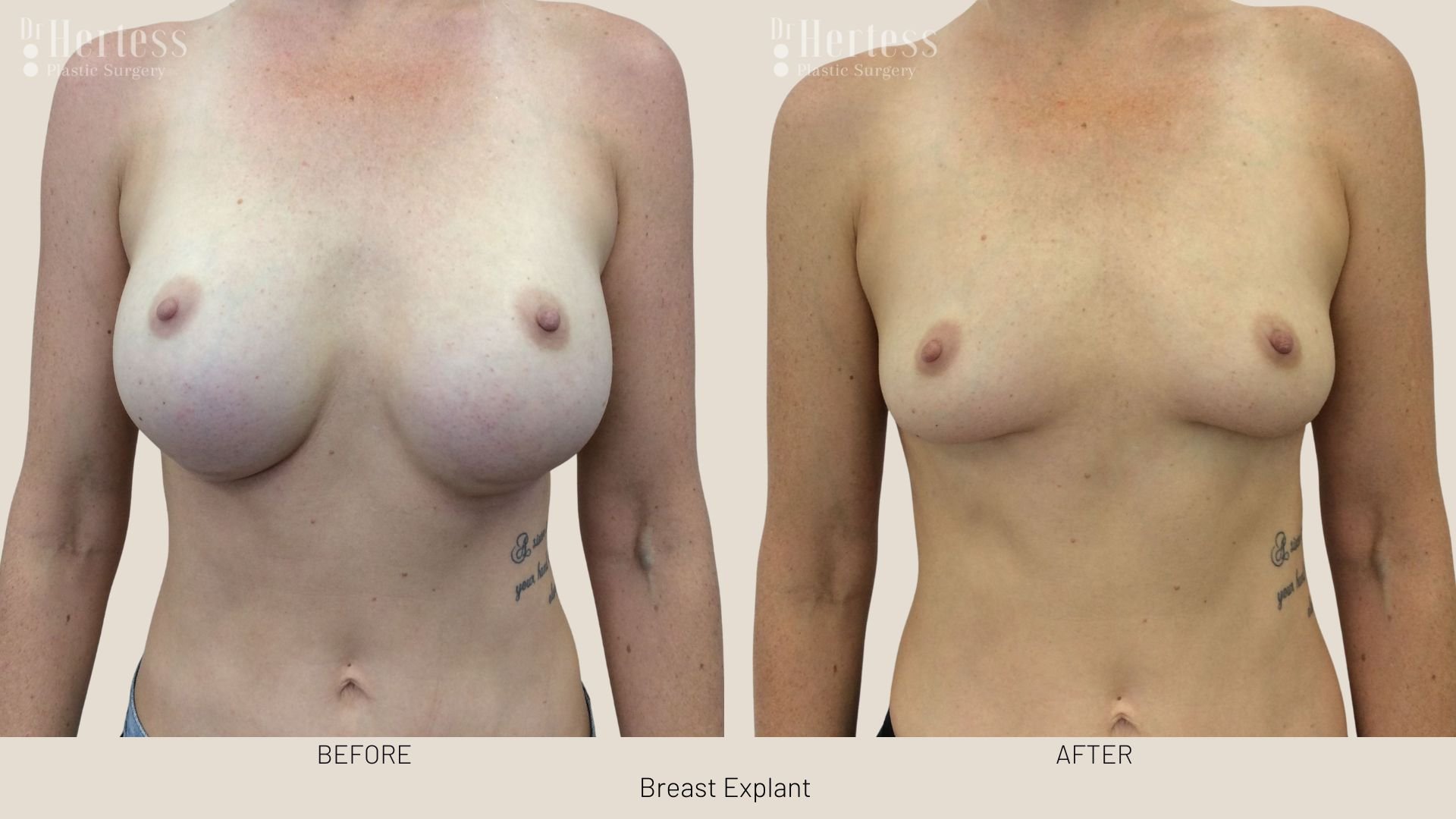 breast implant removal before and after