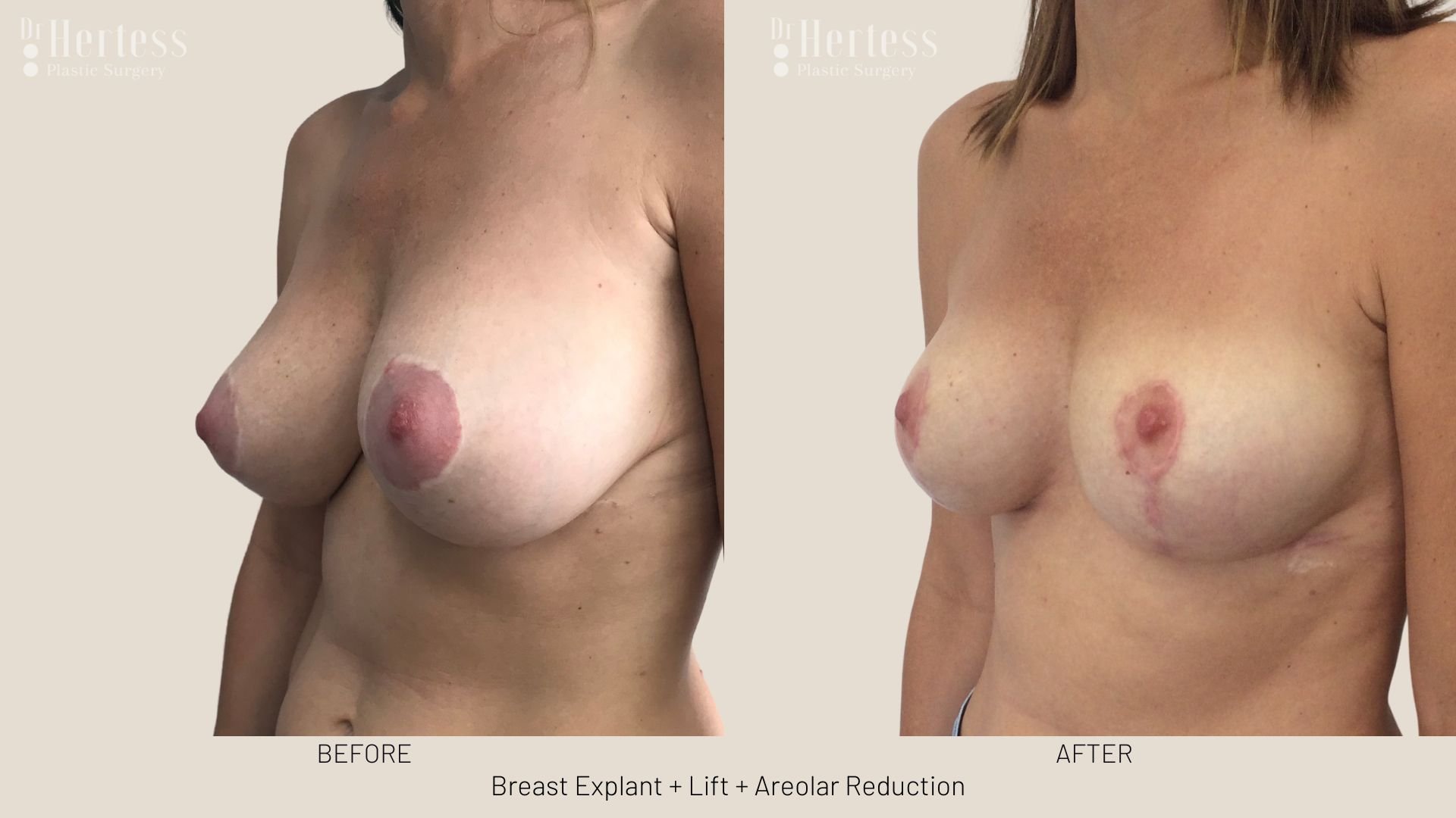 breast explant and lift before and after