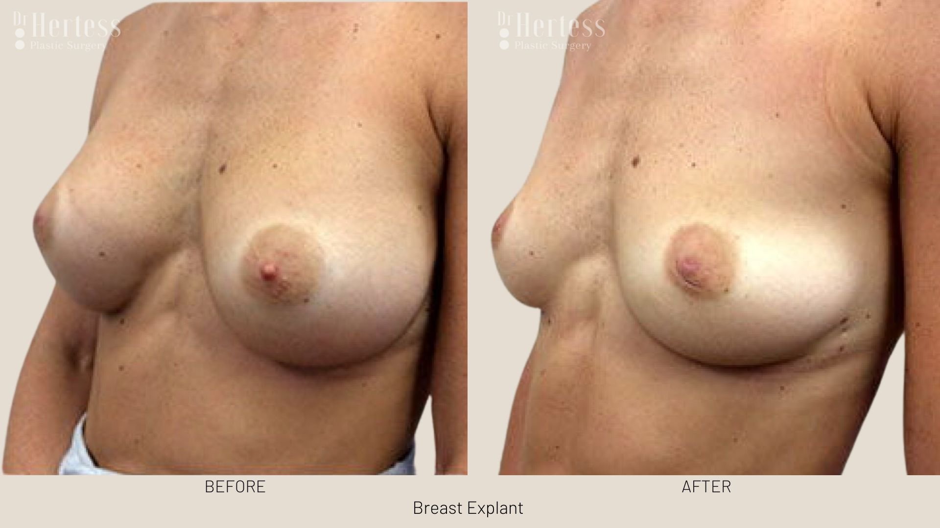 breast implant removal before and after