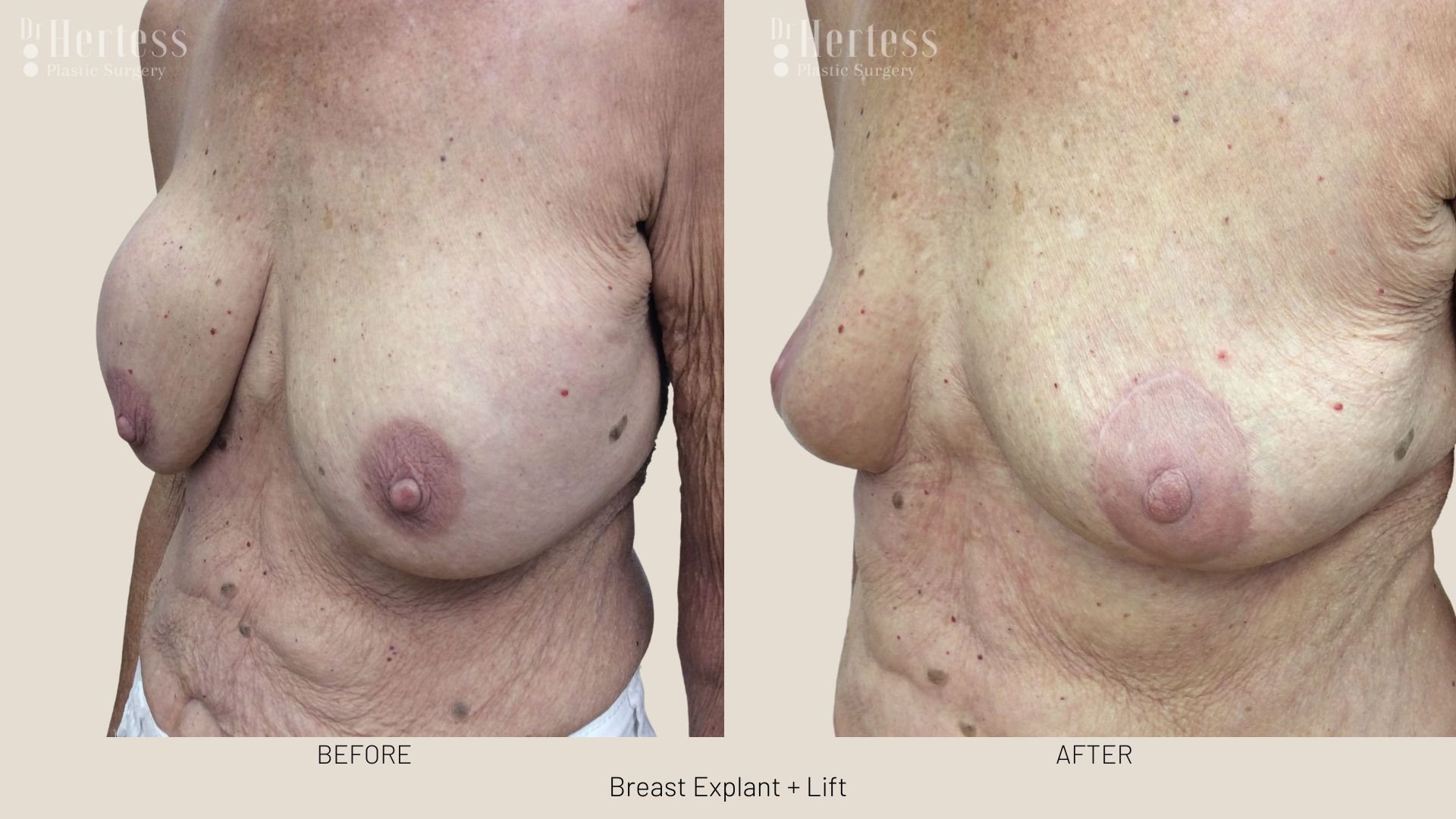 breast explant and lift before and after