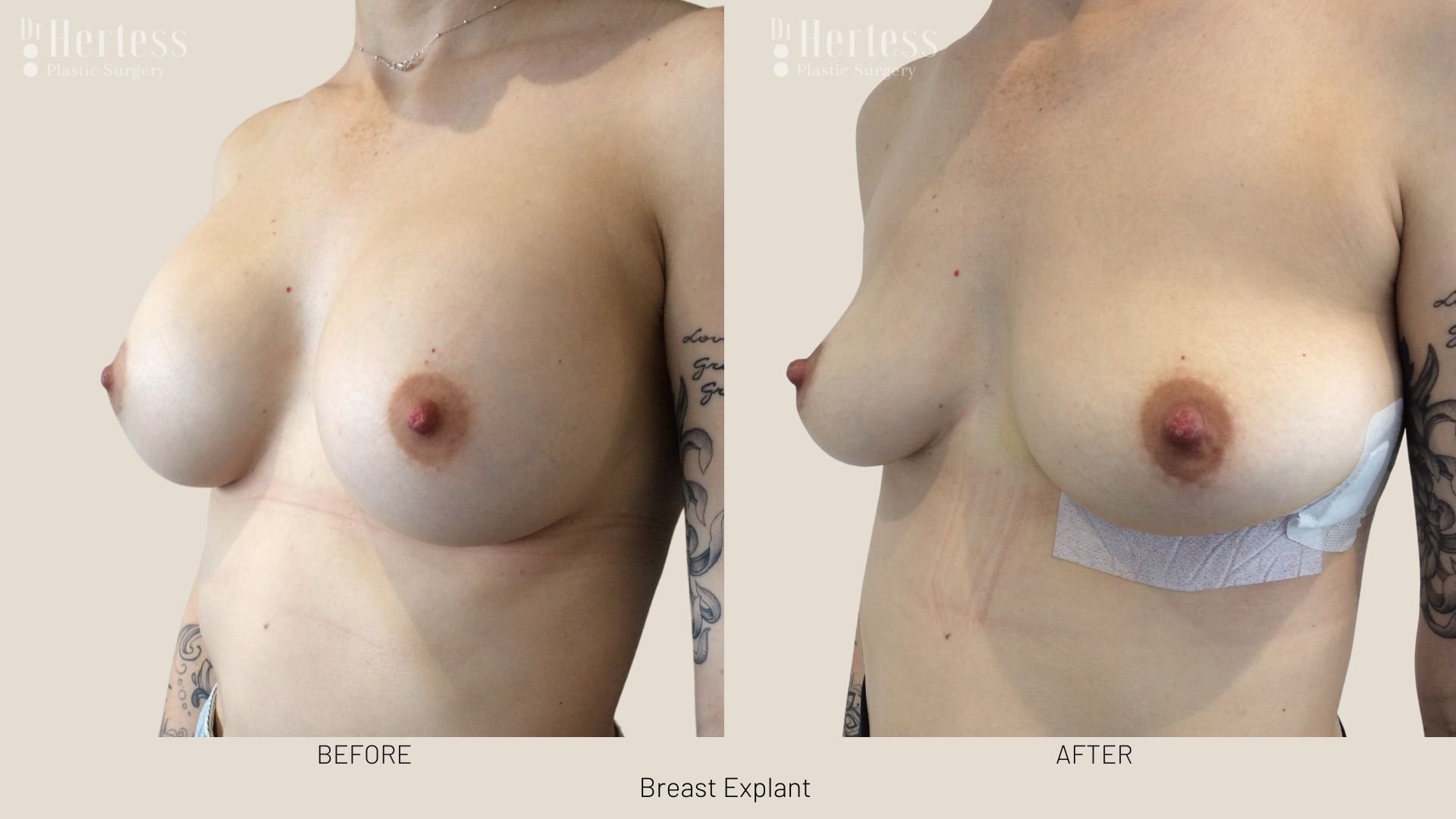 breast implant removal before and after