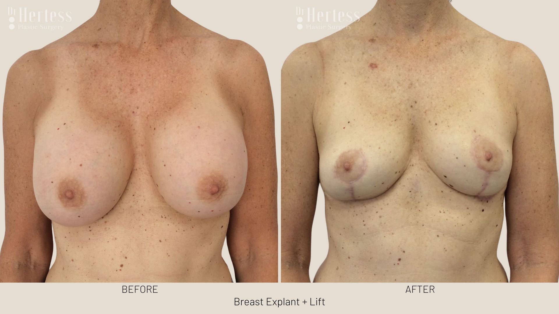 breast explant and lift before and after