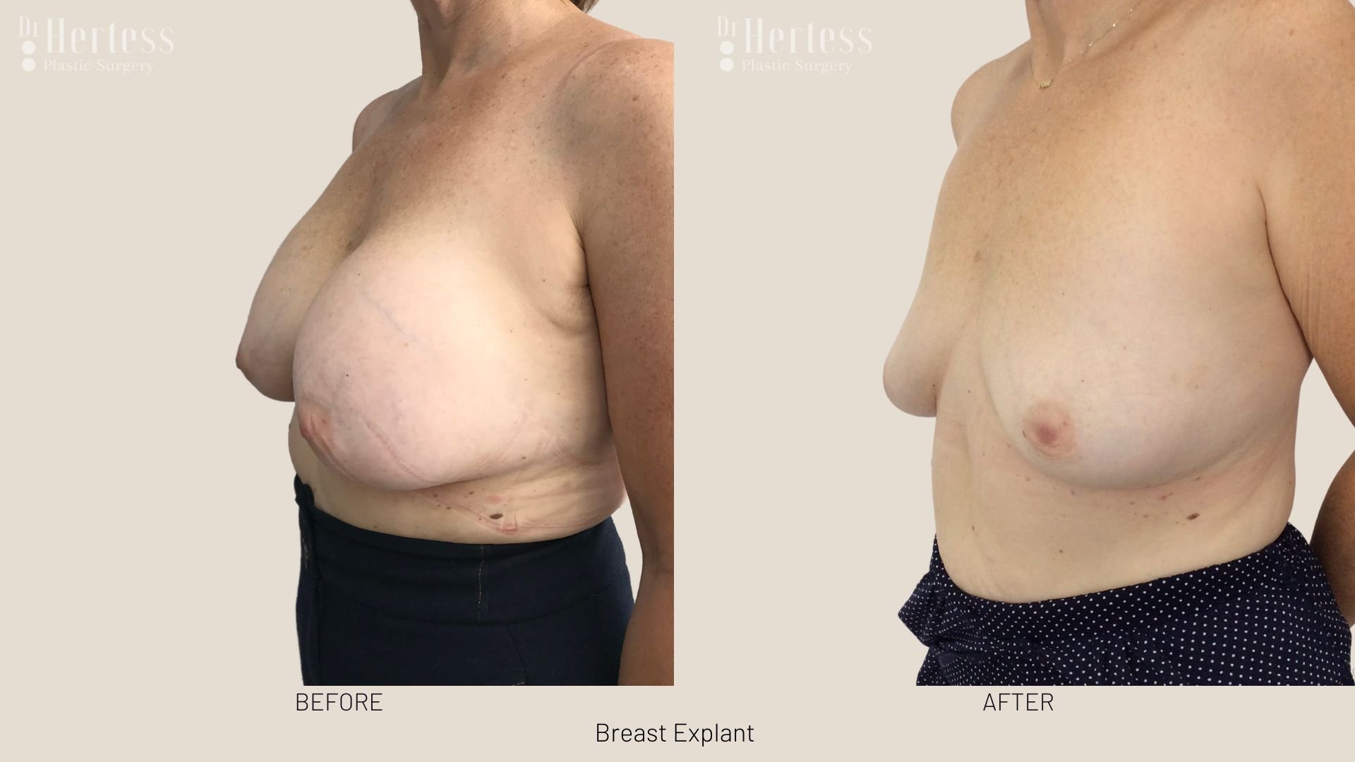 breast implant removal before and after