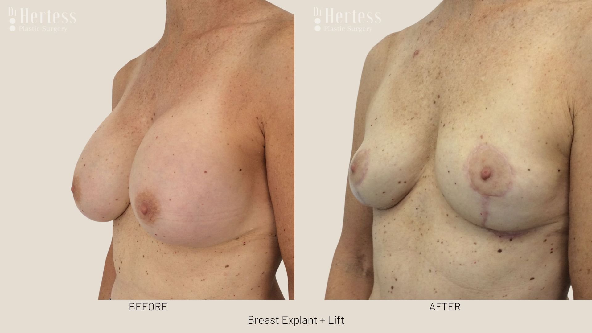 breast explant and lift before and after