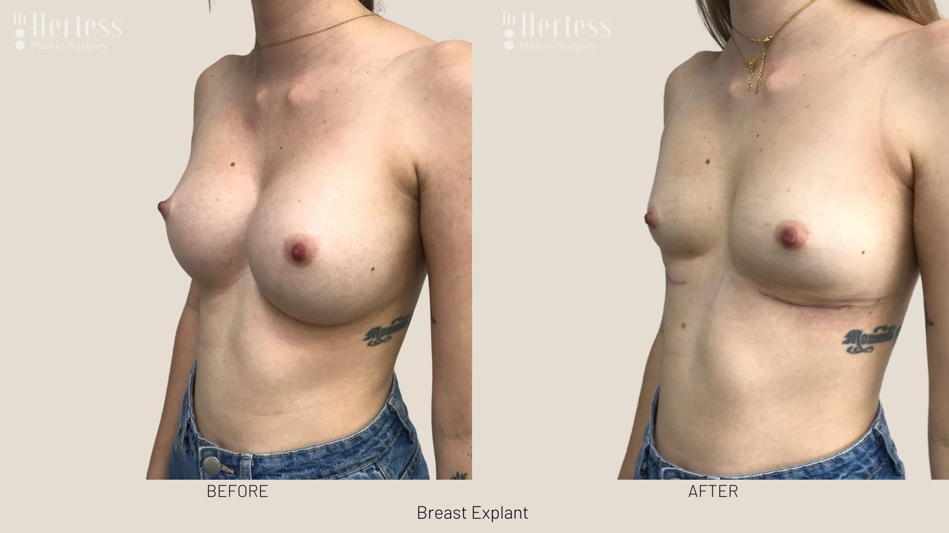 breast implant removal before and after