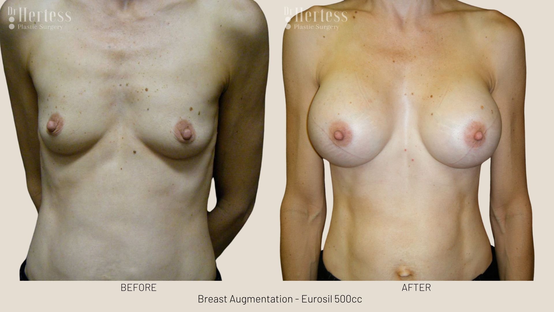 breast implants before and after