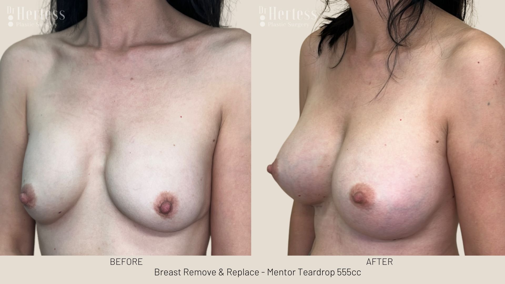 breast implant removal and replacement