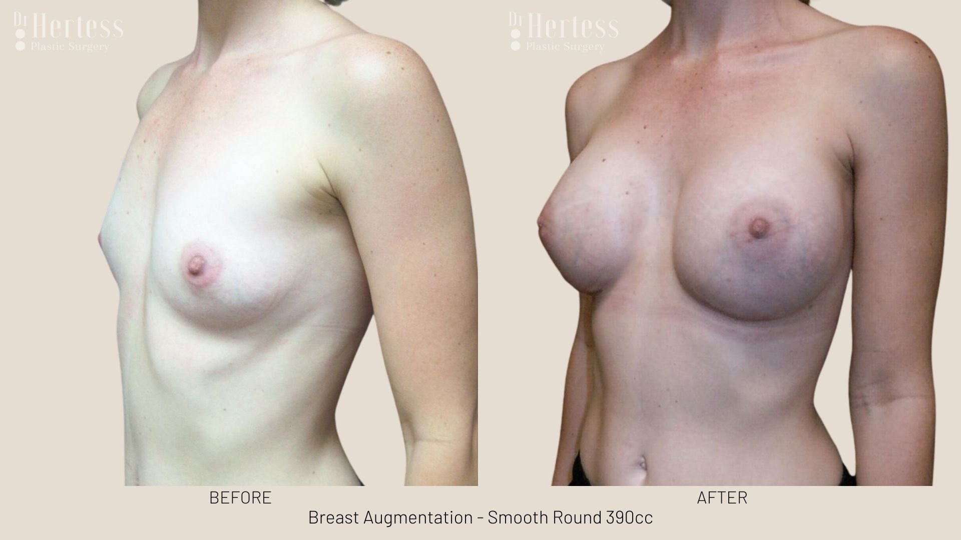 breast aug before and after