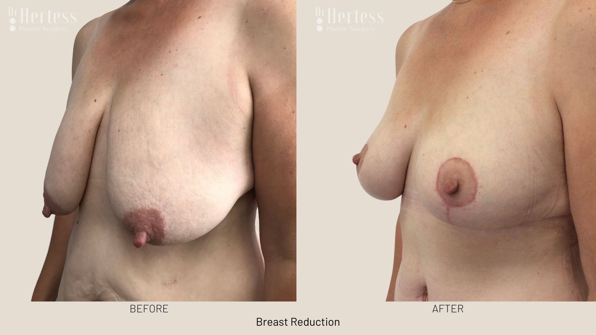 breast reduction photos