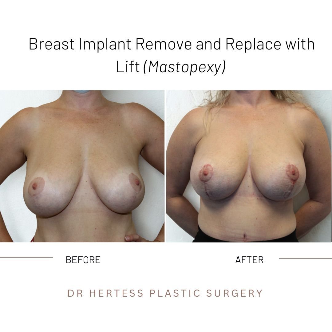 before and after breasts