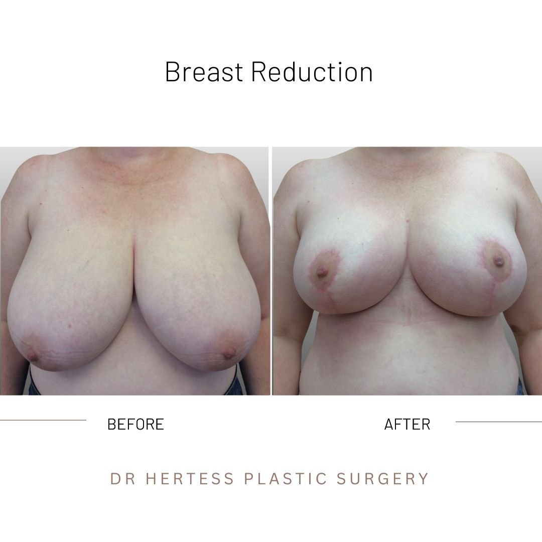 before and after breast reduction