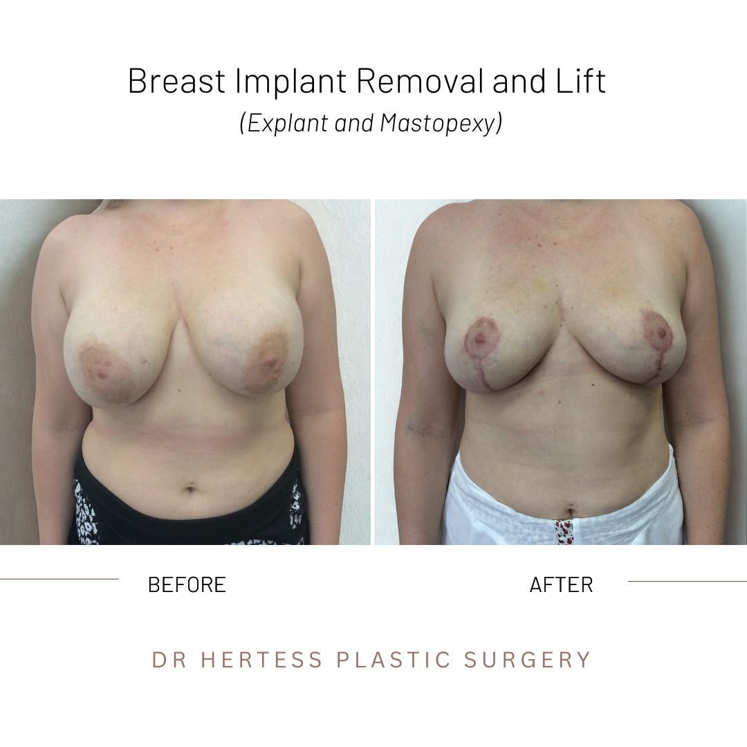 removal and lift before after