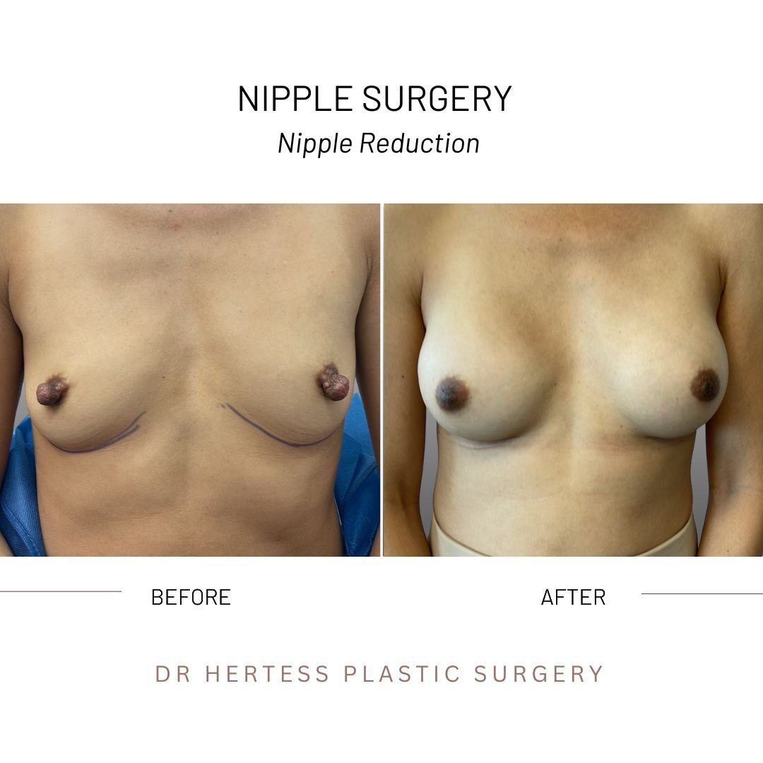 before and after nipple surgery