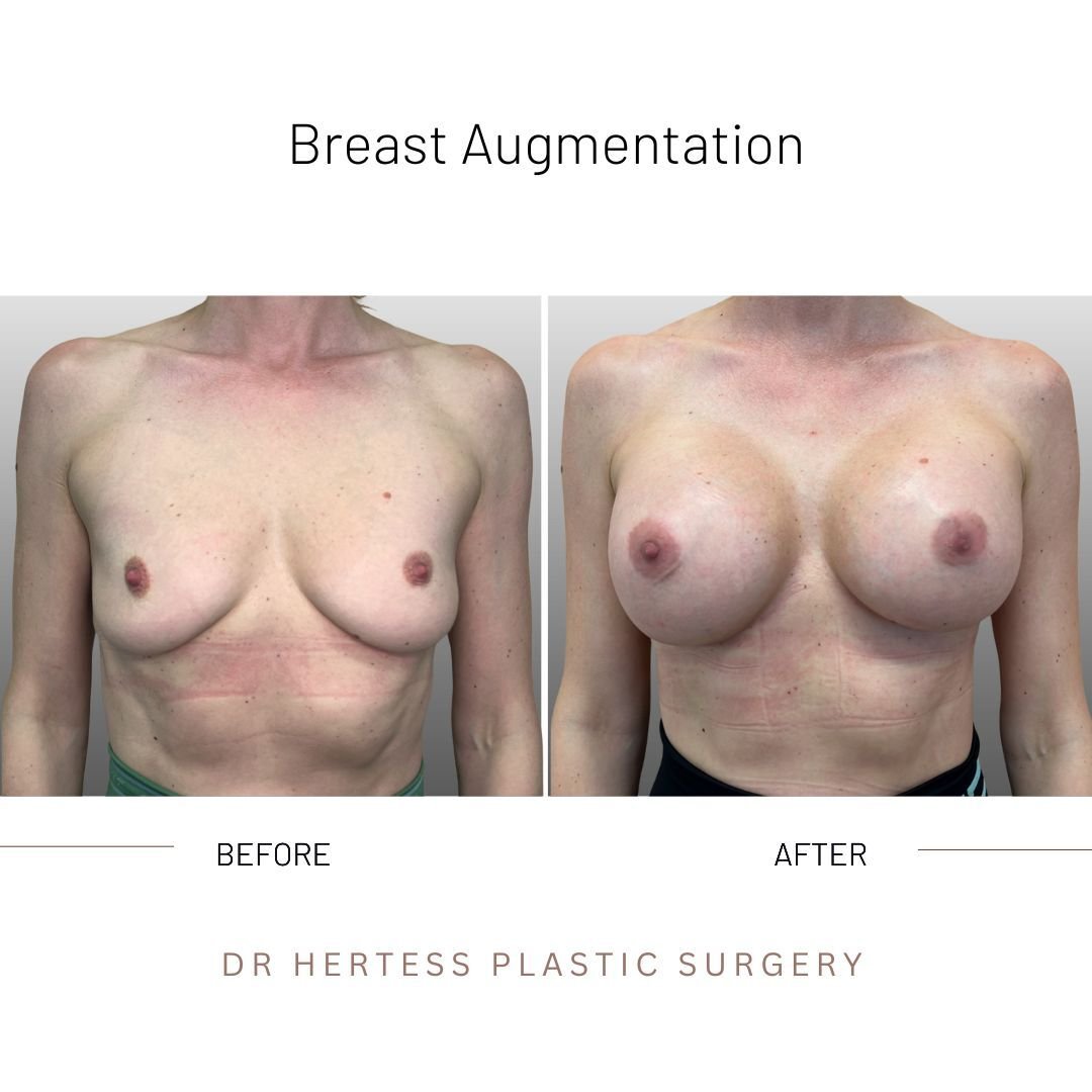 boob job before and after