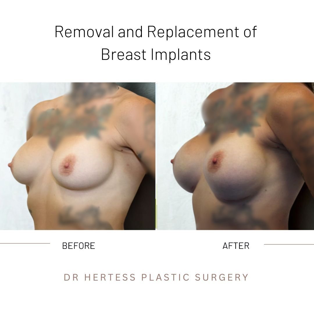 breast implant remove replace before and after