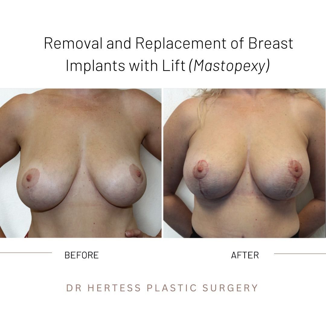 breast remove and replace before and after