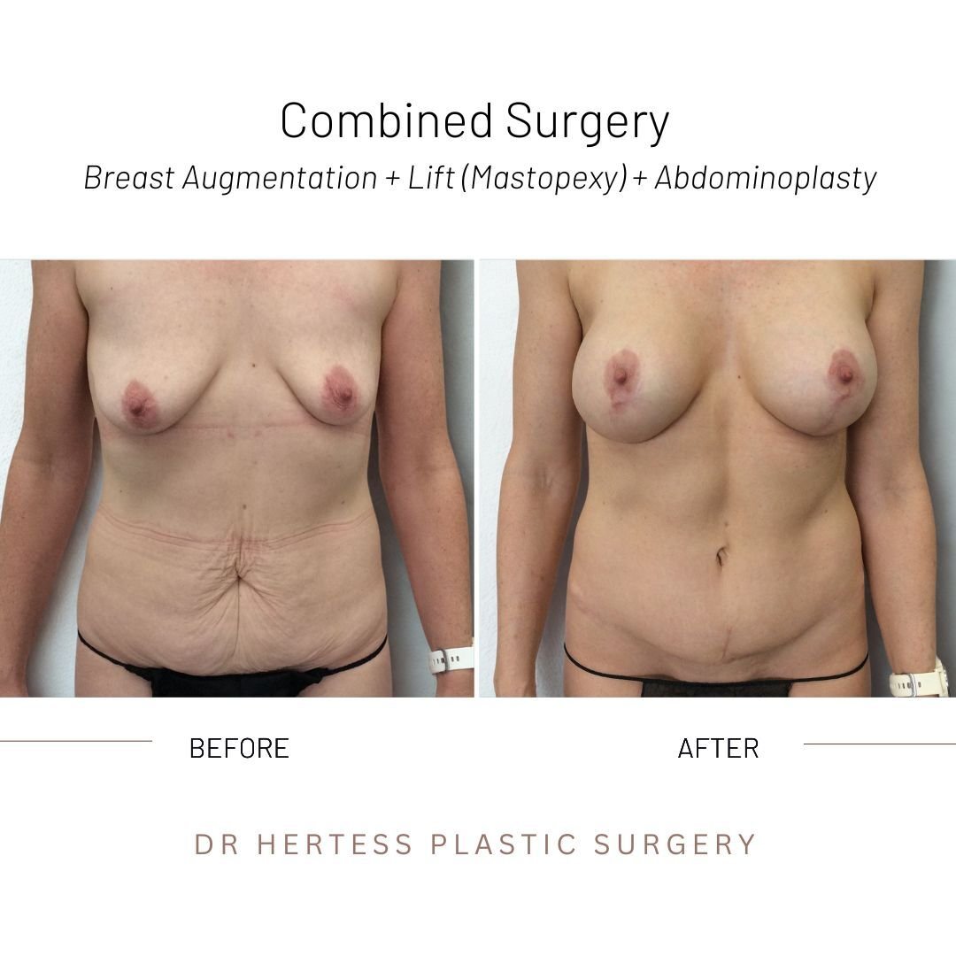 Mummy makeover before after