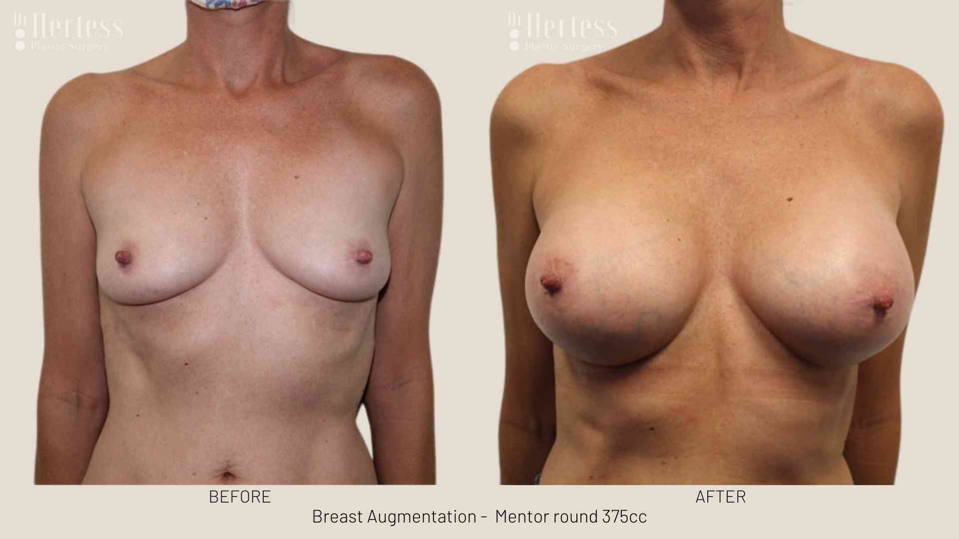 boob job before after