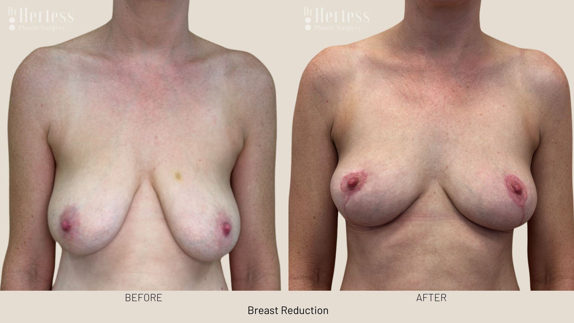 breast reduction photos