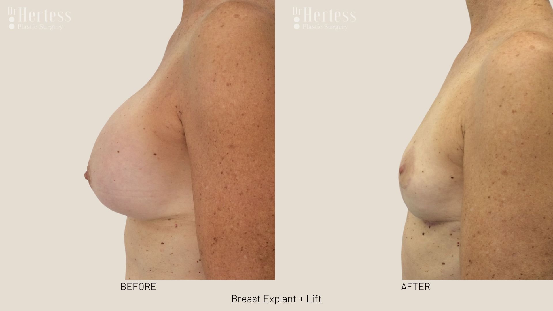 breast explant and lift before and after