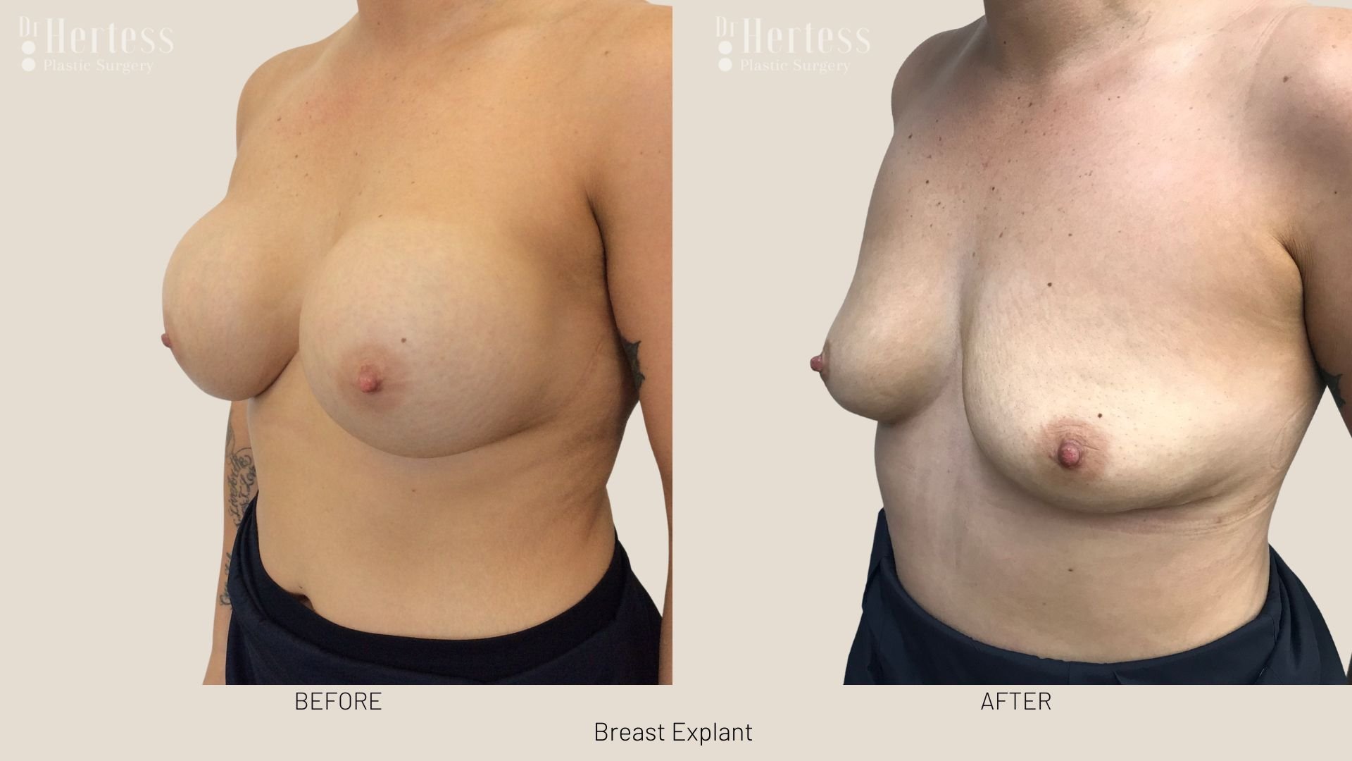 breast implant removal before and after