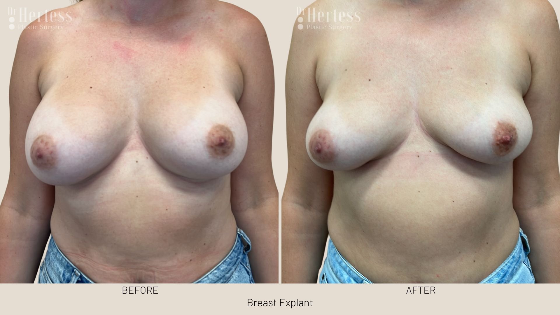 breast implant removal before and after