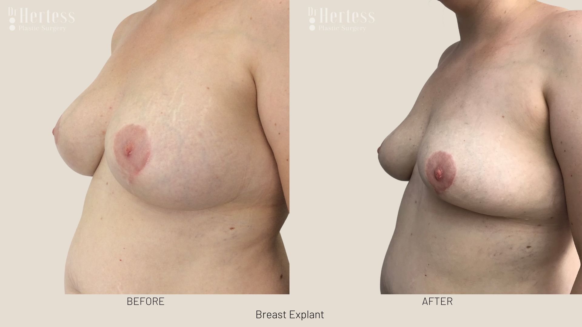 breast explant before and after