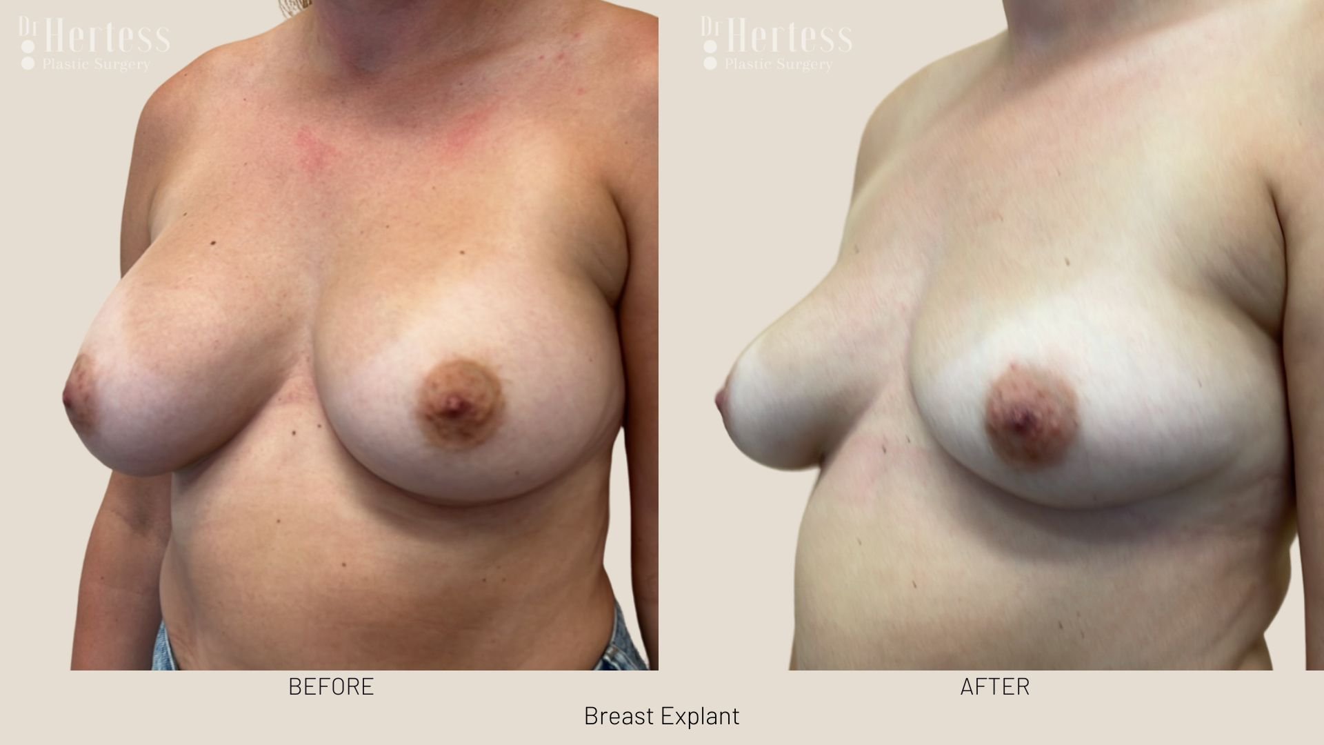 breast implant removal before and after