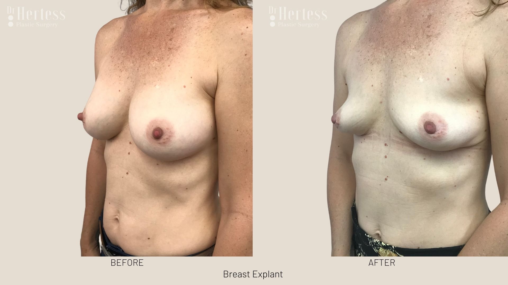 breast implant removal before after