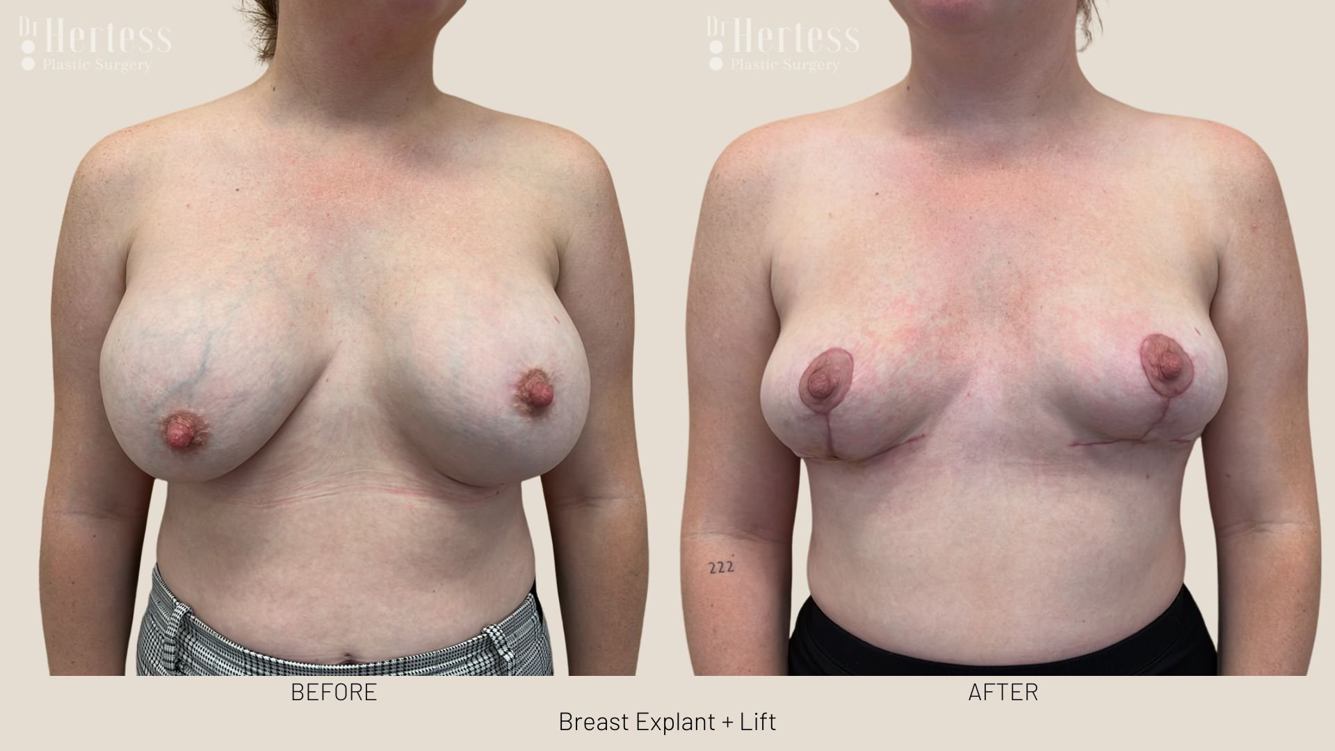 breast explant and lift before and after