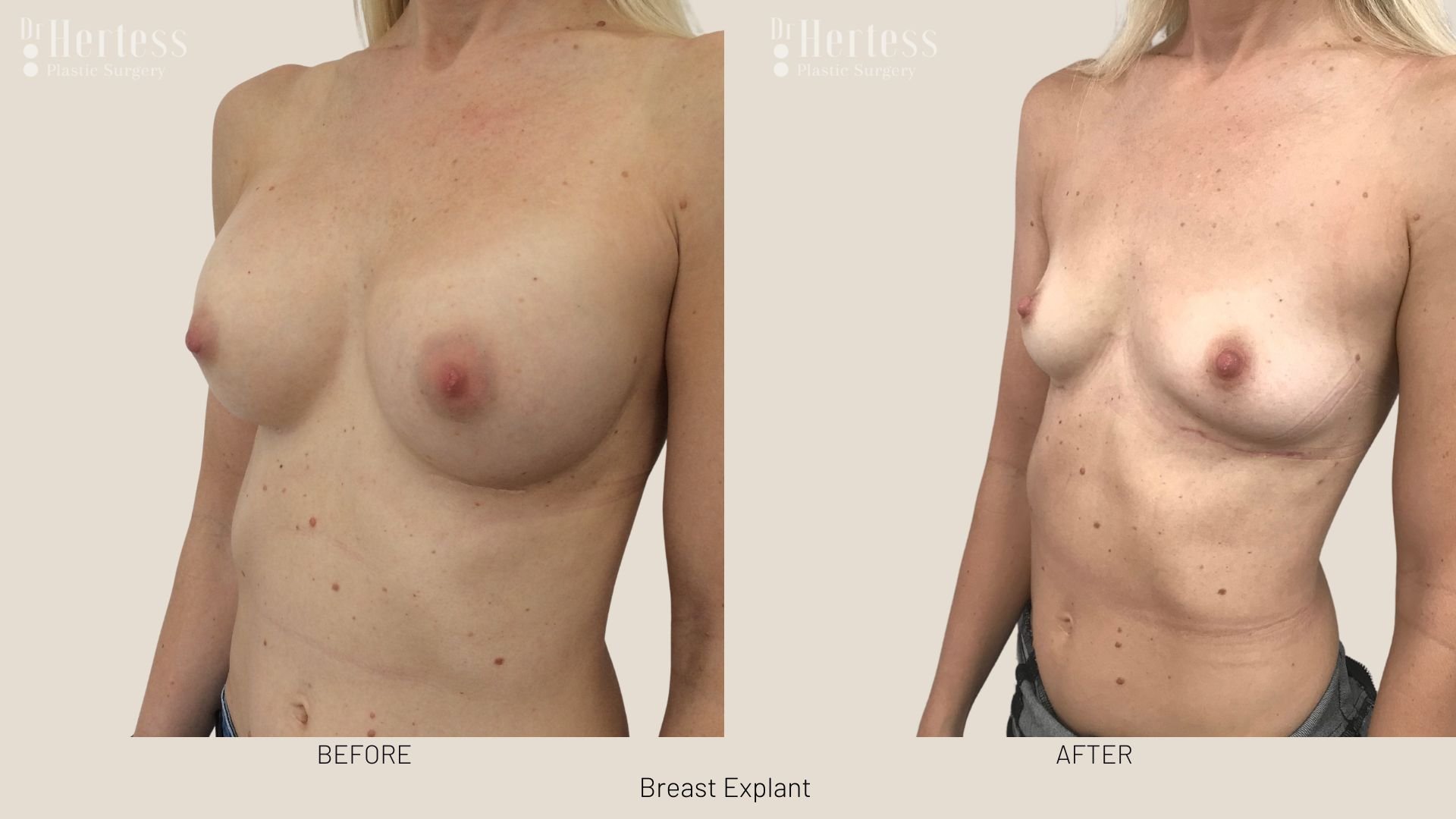 breast implant removal before after