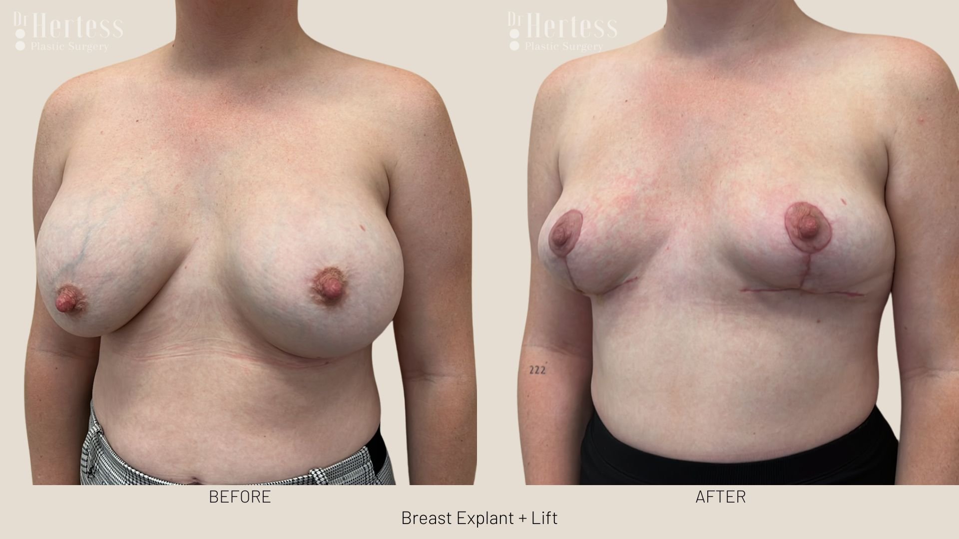 breast explant and lift before and after