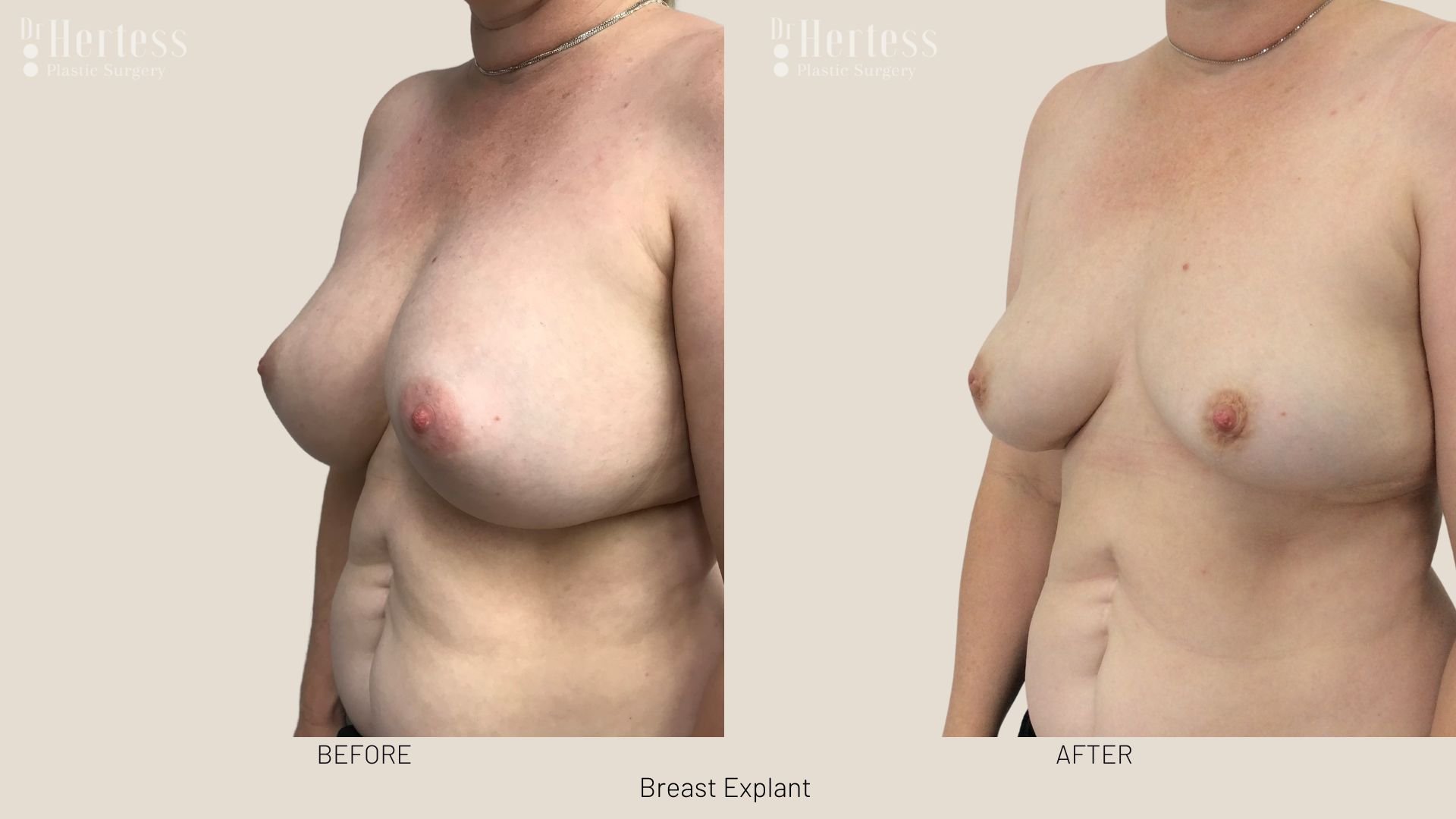 breast implant removal before after