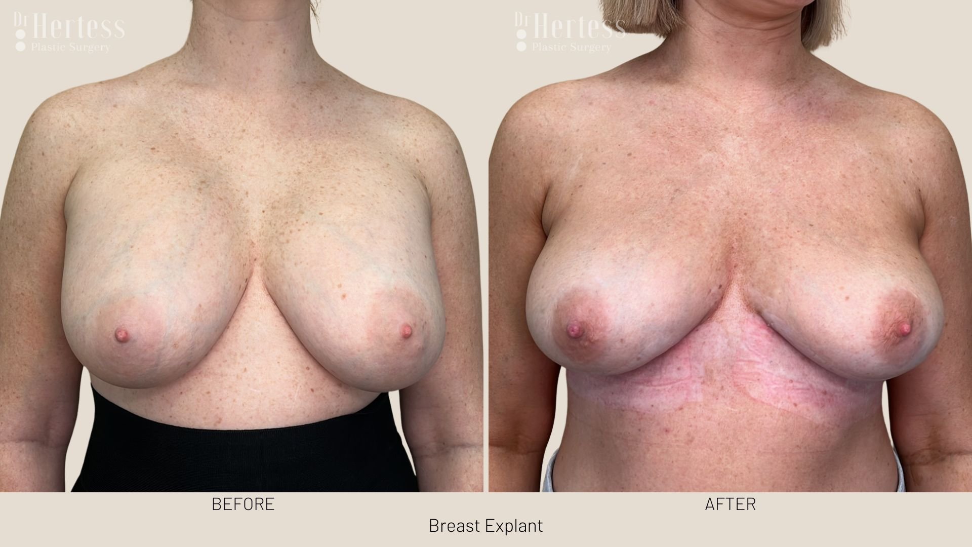 breast implant removal before and after