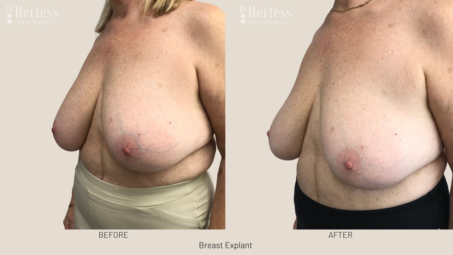 breast explant before and after