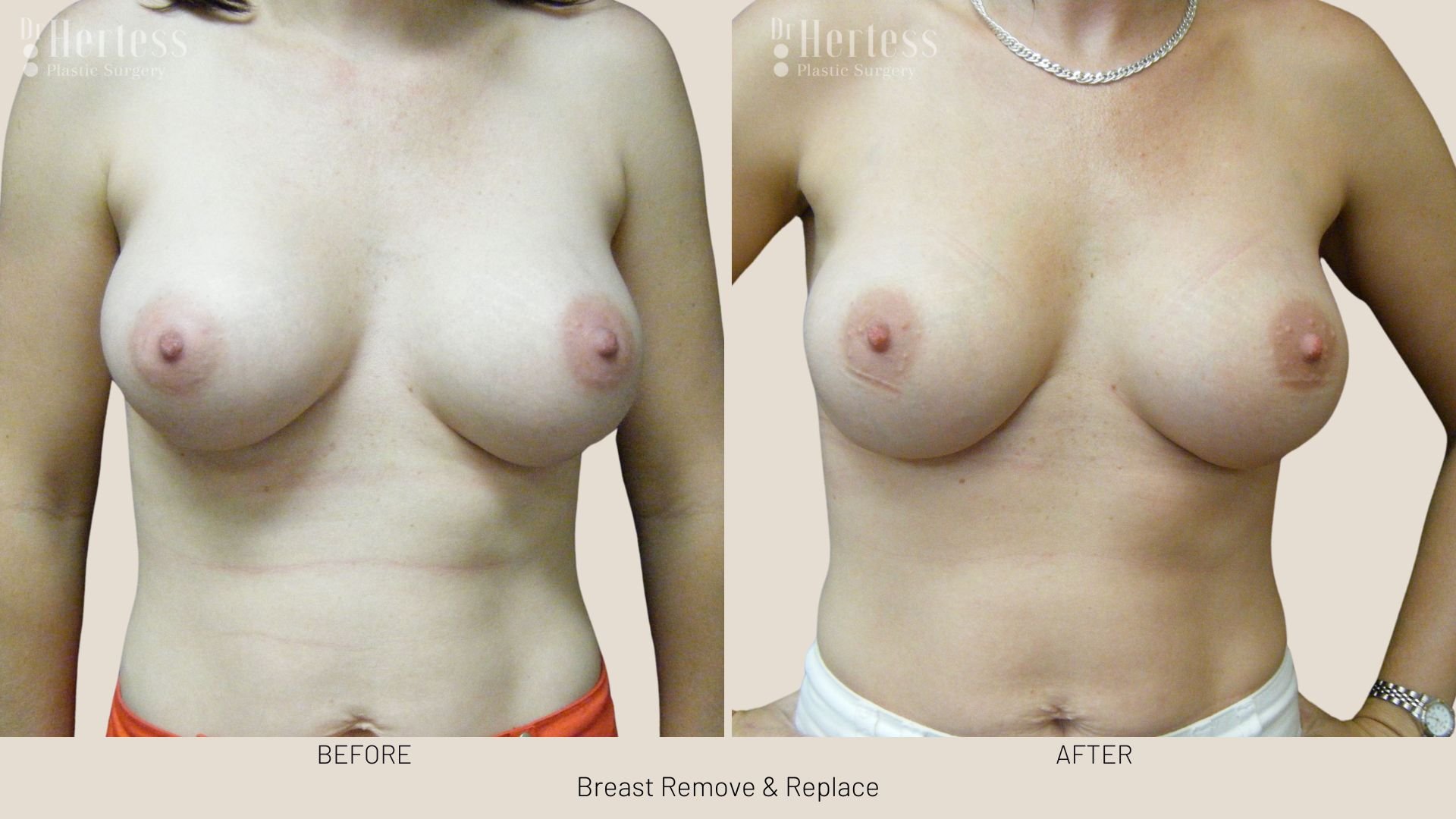 breast implant removal and replacement