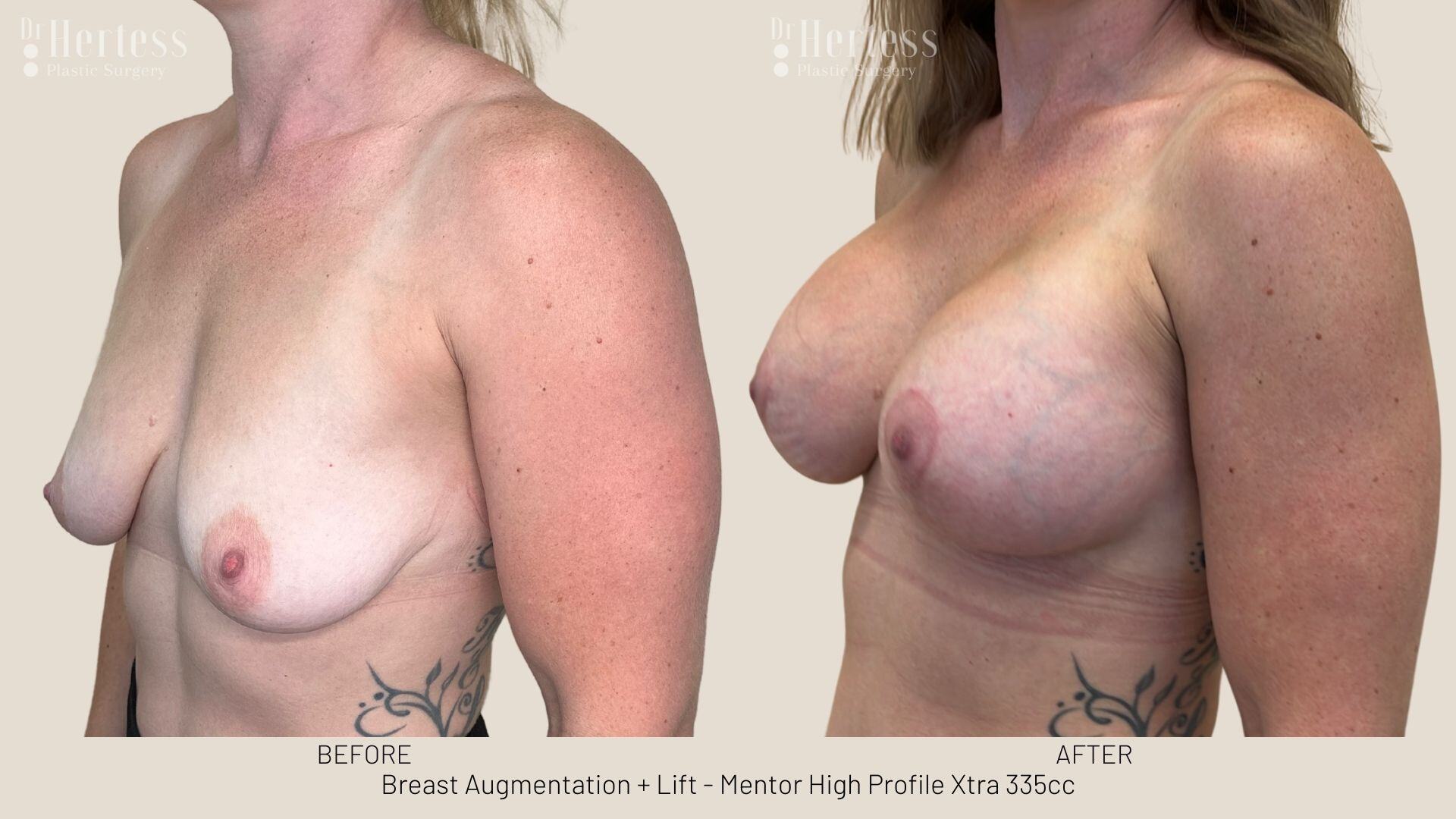 breast lift and implants photos
