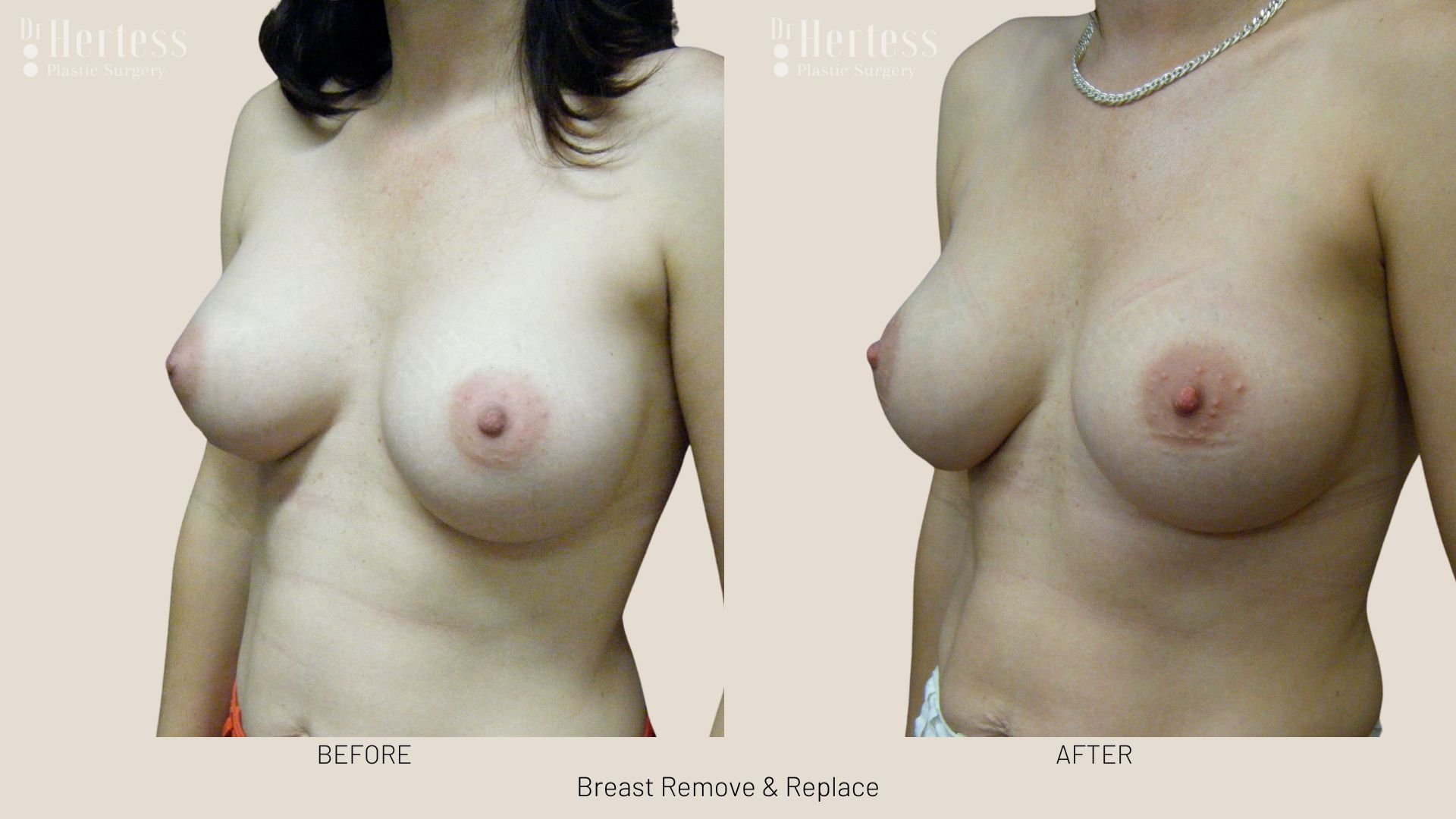 breast implant removal and replacement