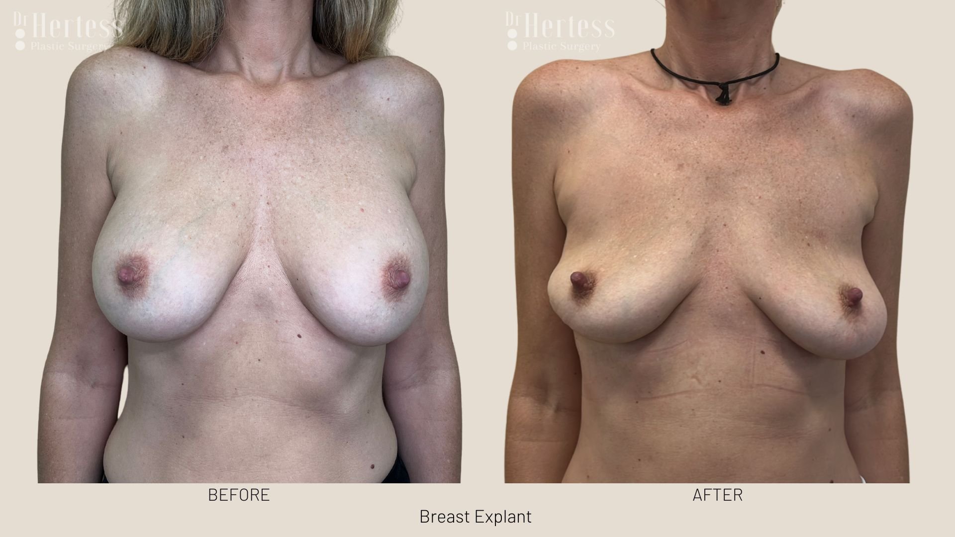 breast explant before and after