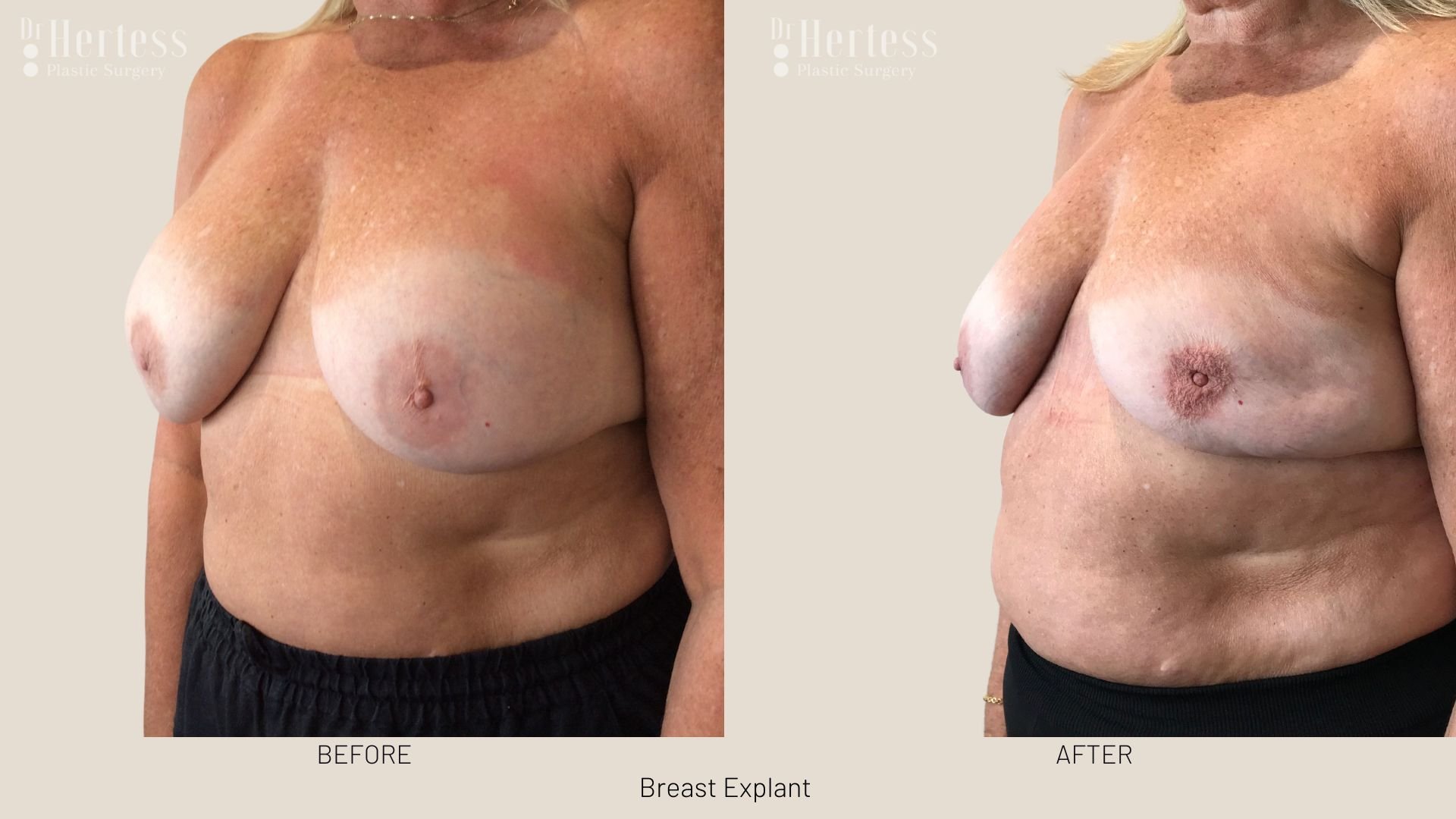 breast explant before and after