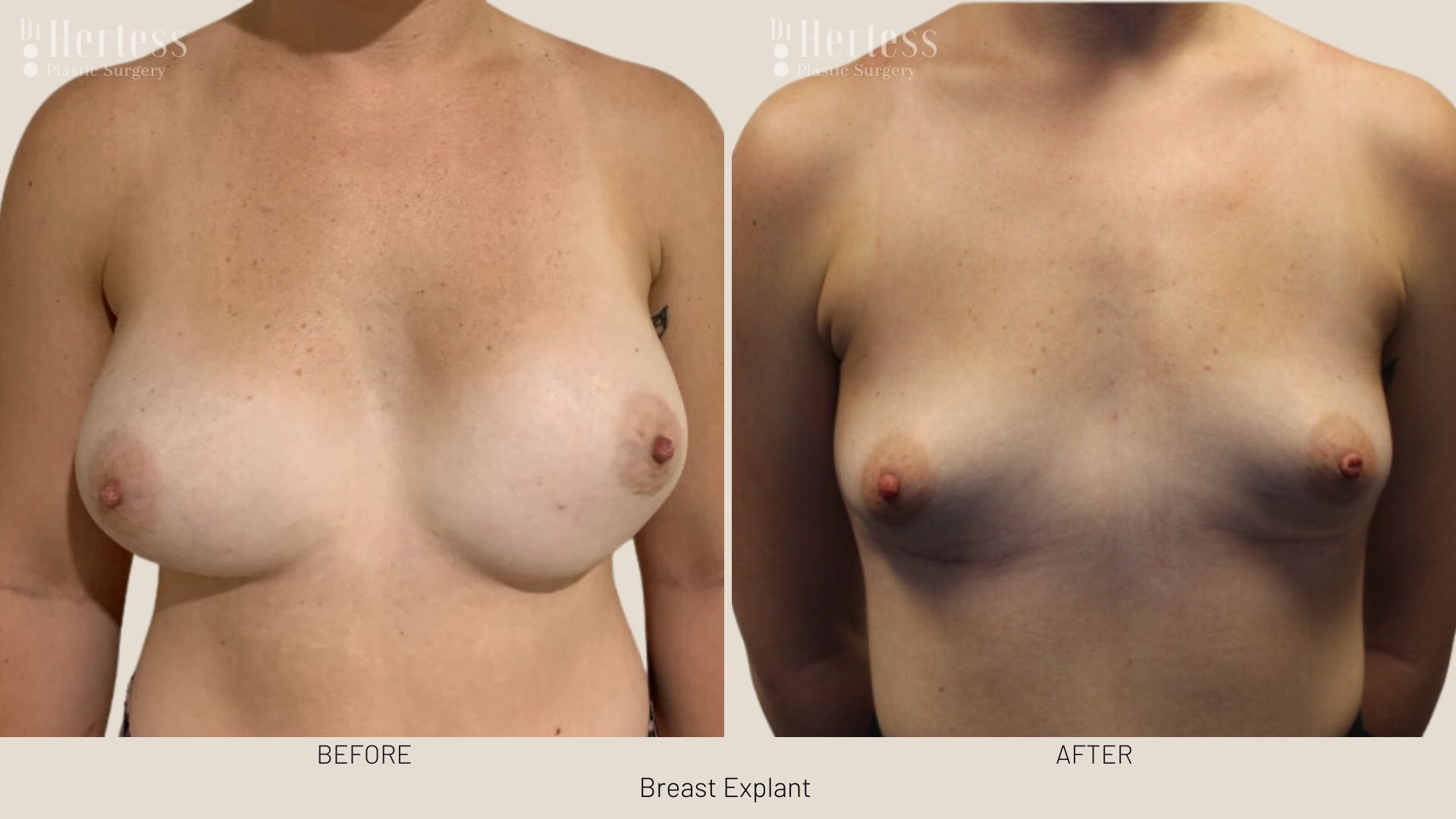 breast implant removal before after