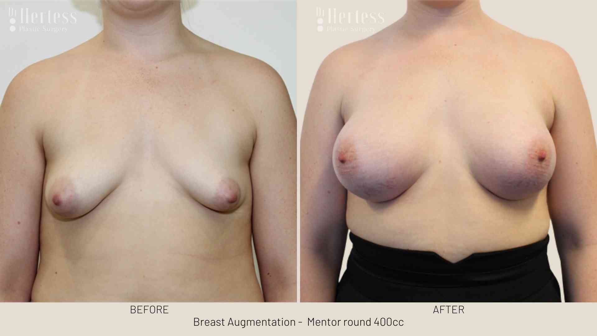 boob job before after